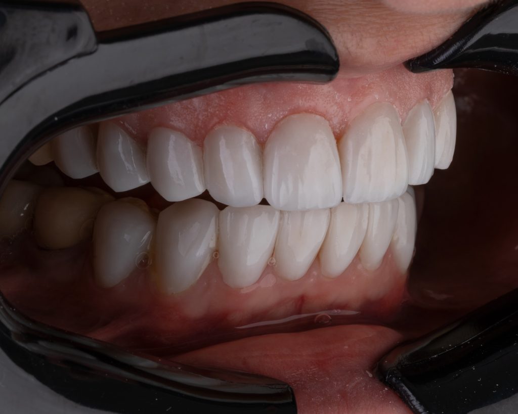 Full Process of Wisdom Teeth Removal